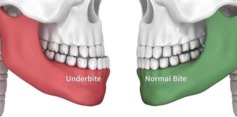 Here’s How To Tell Overbite Vs Normal Teeth Bite