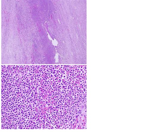 Hidradenitis Suppurativa Histology