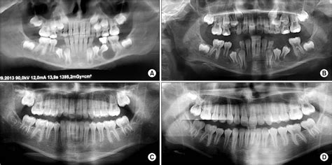 Eruption Cyst Radiograph