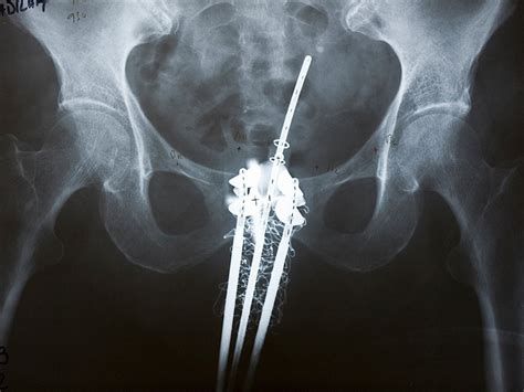 Backing Off From Brachytherapy? Deciphering the Decline