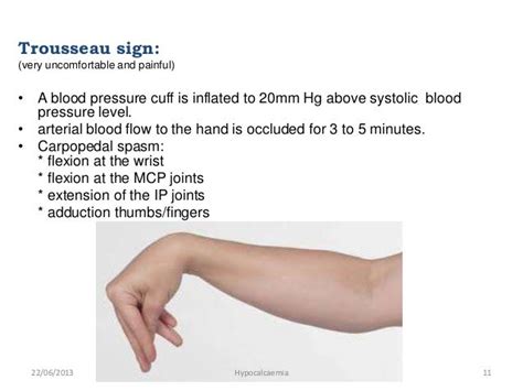 Hypocalcaemia