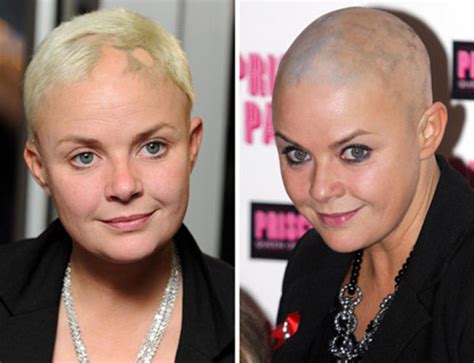 Gail Porter goes back to shaving her head as alopecia returns | London ...