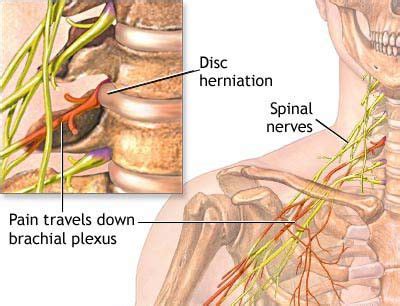 Treatment of Pinched Nerve in the Neck in NJ | Pain Management Doctor