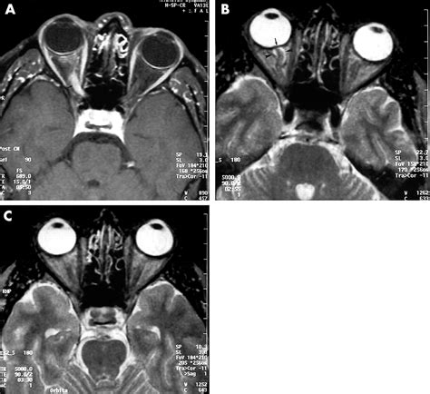 Optic neuritis with marked distension of the optic nerve sheath due to ...