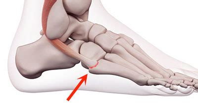 Outside Foot Pain - Symptoms, Causes, Treatment & Rehabilitation