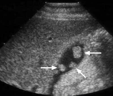 Gallbladder Polyps - Ultrasound findings on Gallbladder Polyps / myLot