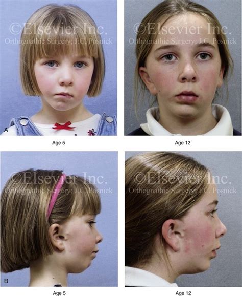 Hemifacial Microsomia: Evaluation and Treatment | Clinical Gate