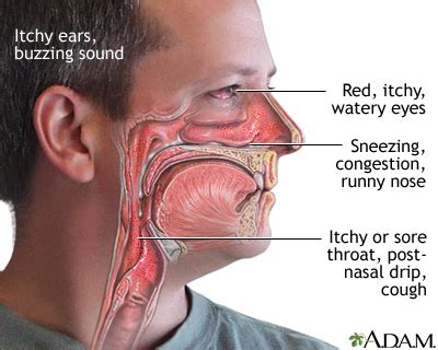 Allergy symptoms: MedlinePlus Medical Encyclopedia Image