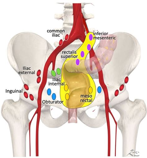 The Radiology Assistant : Rectal Cancer MR staging 3.0