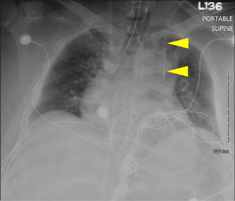 Figure 1 from Double Superior Vena Cava Due to Persistent Left Superior ...