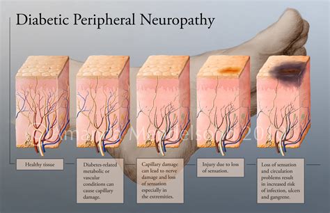 Diabetes and Foot Care: Diabetic Neuropathy - Gluxus Health - COMFORTAID