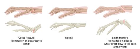 Colles Fracture Classification