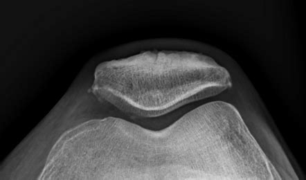 Patellar tooth sign of degenerative enthesopathy | Radiology Case ...