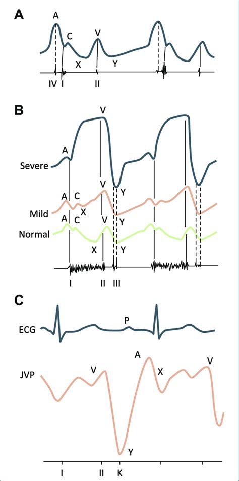 Abnormal jugular venous waveforms [34]. (A) Large A waves associated ...