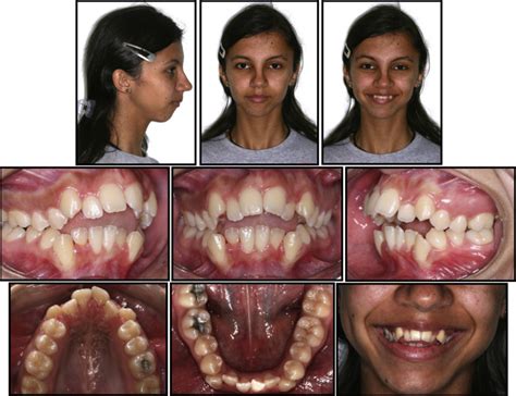 Camouflage of a high-angle skeletal Class II open-bite malocclusion in ...