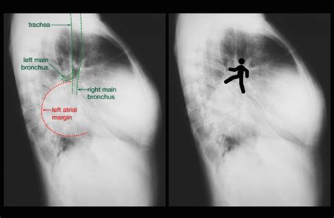 Left Atrial Enlargement X Ray