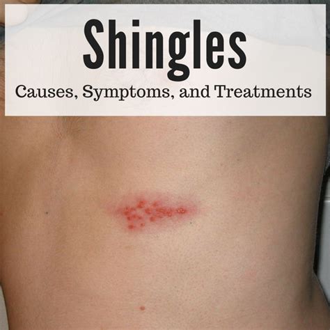 Shingles: A Serious and Painful Disease | HealthProAdvice