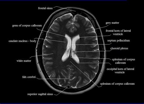 Ct Scan Brain Anatomy : Anatomy Of Head Ct Scan Normal The Brain On Ct ...