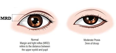 Droopy Eyelids Among the Elderly: Is it Worth Getting Surgery? | Dream ...