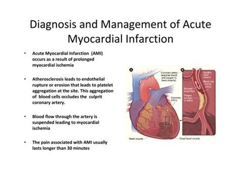 Diagnosis and Management of Acute Myocardial Infarction