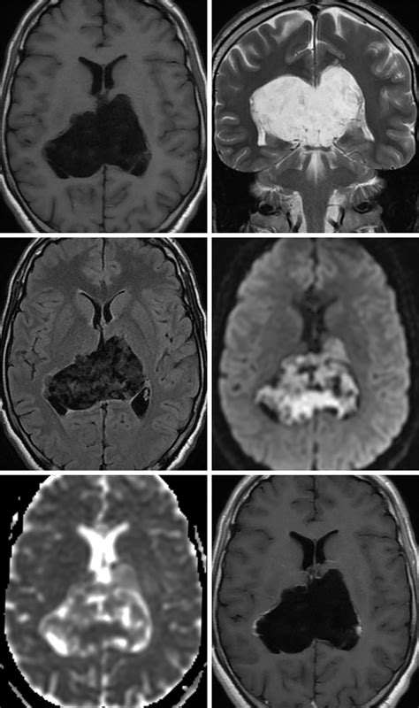 Epidermoid Cyst | The Neurosurgical Atlas