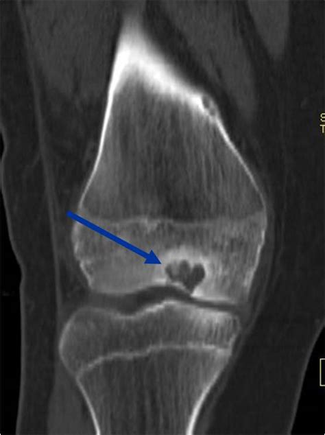 Chondroblastoma : Bone Tumors : Tumors of the bone