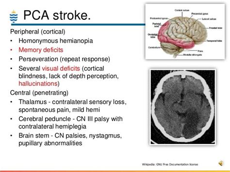 Gross Anatomy, Brain Anatomy, Memory Deficit, Complex Migraine, Caudate ...