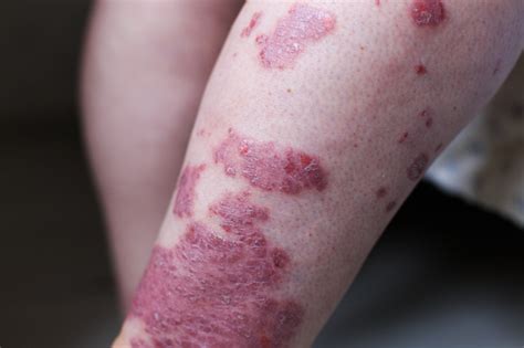 What are the Signs and Symptoms of Psoriatic Arthritis?