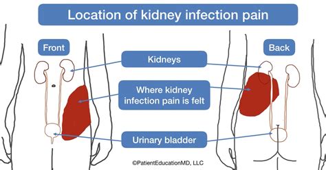 Kidney Pain Location