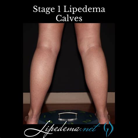 Learn About Stages and Types of Lipedema | Lipedema.net