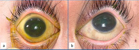 Cureus | Xerophthalmia in Picky Eater Children