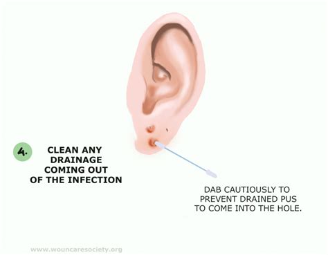 How to drain infected ear piercing - Wound Care Society