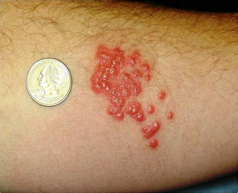 Bed Bug Bite Signs, Symptoms, Pictures and Treatment