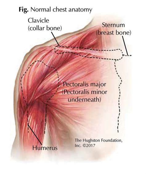 Chest Muscle Injuries: Strains and Tears of the Pectoralis Major ...