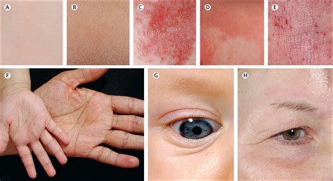 Atopic dermatitis - The Lancet