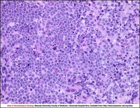 Burkitt lymphoma - CELL - Atlas of Haematological Cytology