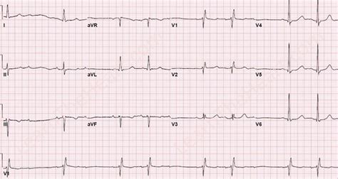 Second Degree AV Block Type II ECG | Learn the Heart