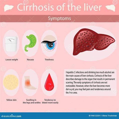 Symptoms of Cirrhosis Oh the Liver. Stock Vector - Illustration of ...