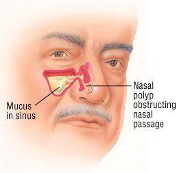 Nasal Polyps Guide: Causes, Symptoms and Treatment Options