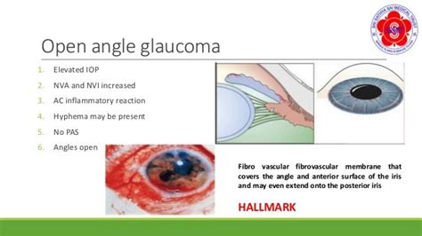 neovascular glaucoma