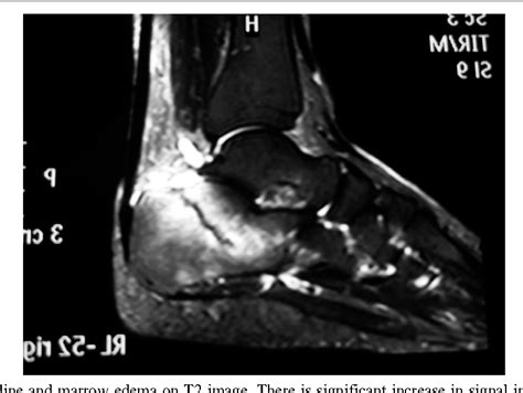 Figure 1 from Bilateral calcaneal stress fractures: a case report ...