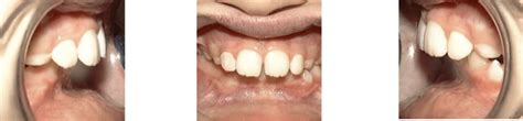 Class 2 Malocclusion Before & After Treatment