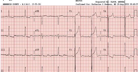 Dr. Smith's ECG Blog: Left Ventricular Hypertrophy May Result in ...