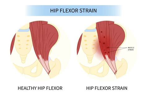 8 Strengthening Hip Flexor Exercises for Seniors