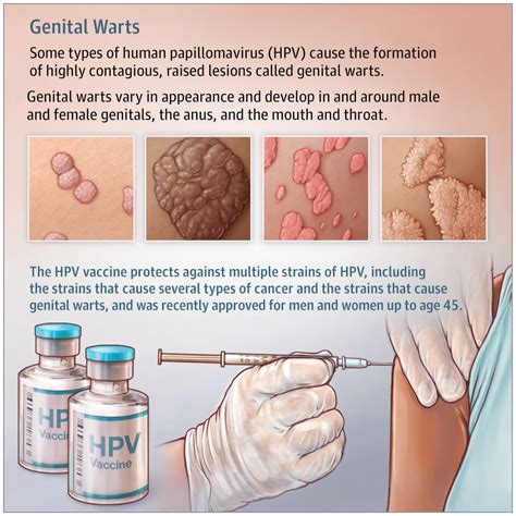 Genital Warts | Infectious Diseases | JAMA | JAMA Network