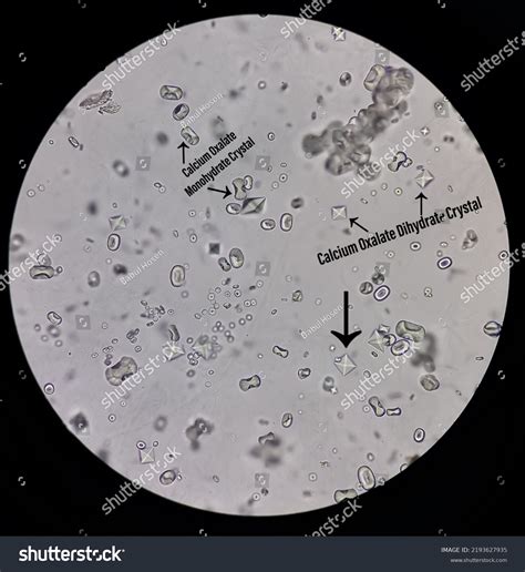 Calcium Oxalate Dihydrate Crystals In Urine