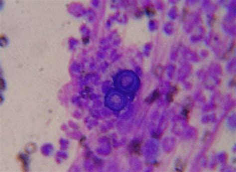 Blastomycosis Histology