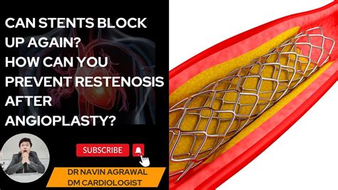 Angioplasty Success: Avoiding Stent Restenosis! (Proven Tips)" - YouTube