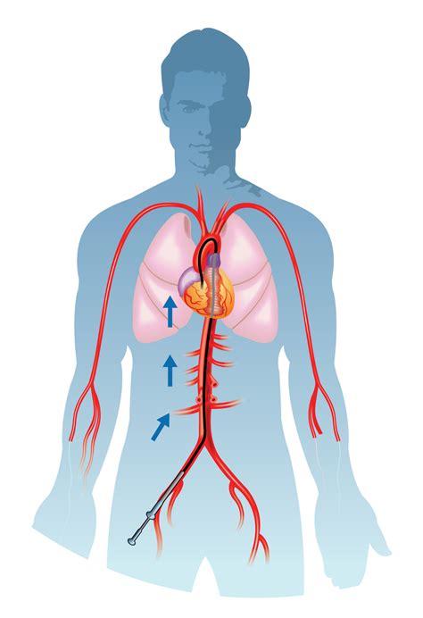 Coronary Angiogram/Angioplasty Pre-procedure guide - CVSKL