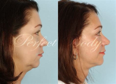 Perfect Body Laser and Aesthetics: Non-Invasive Surgery Alternatives at ...